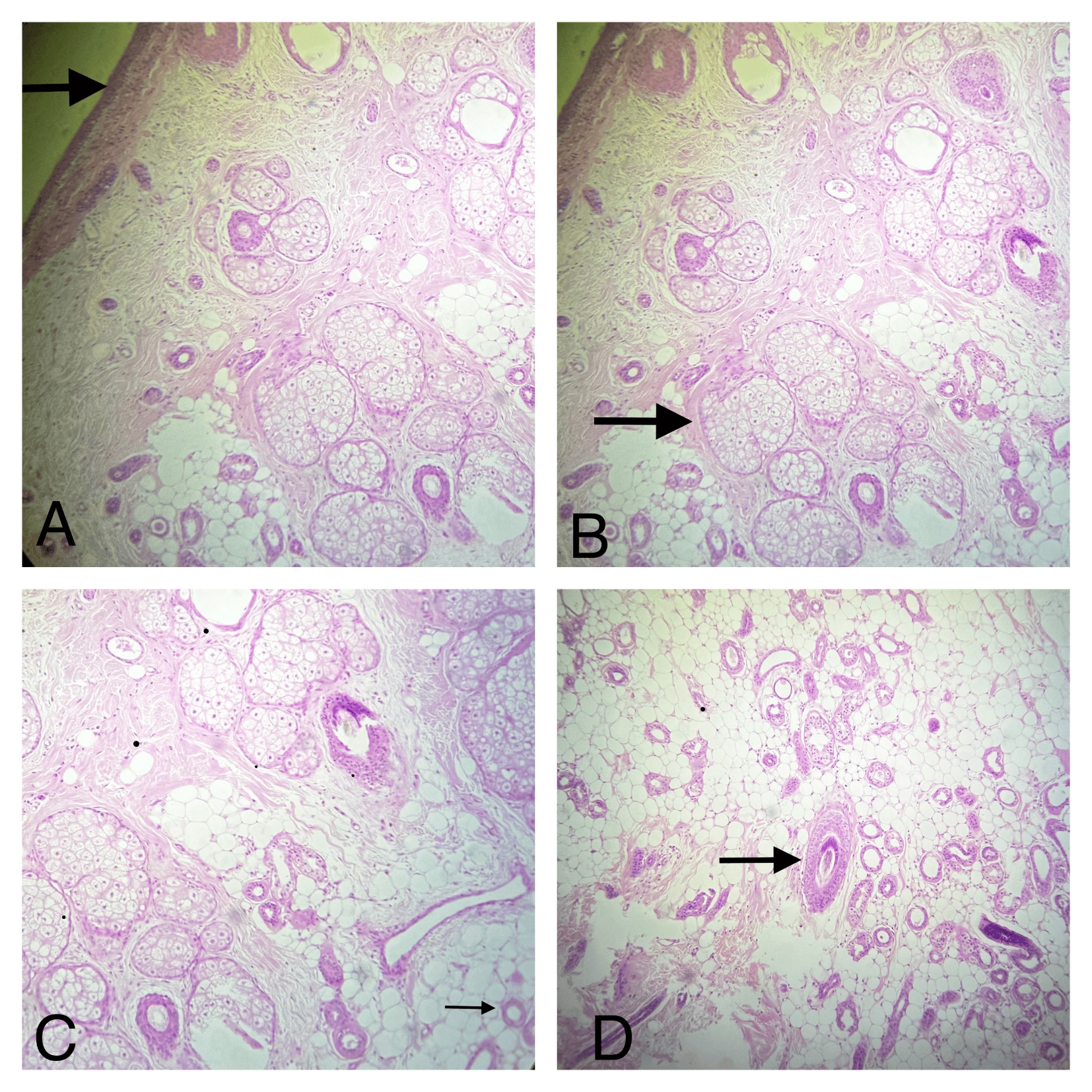 ovarian-dermoid-cyst-histology